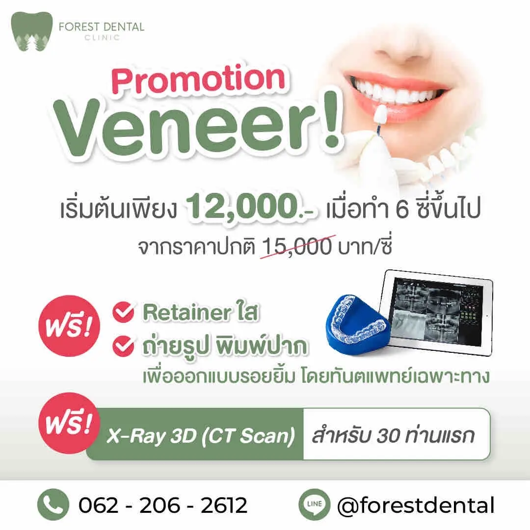 implant and veneer