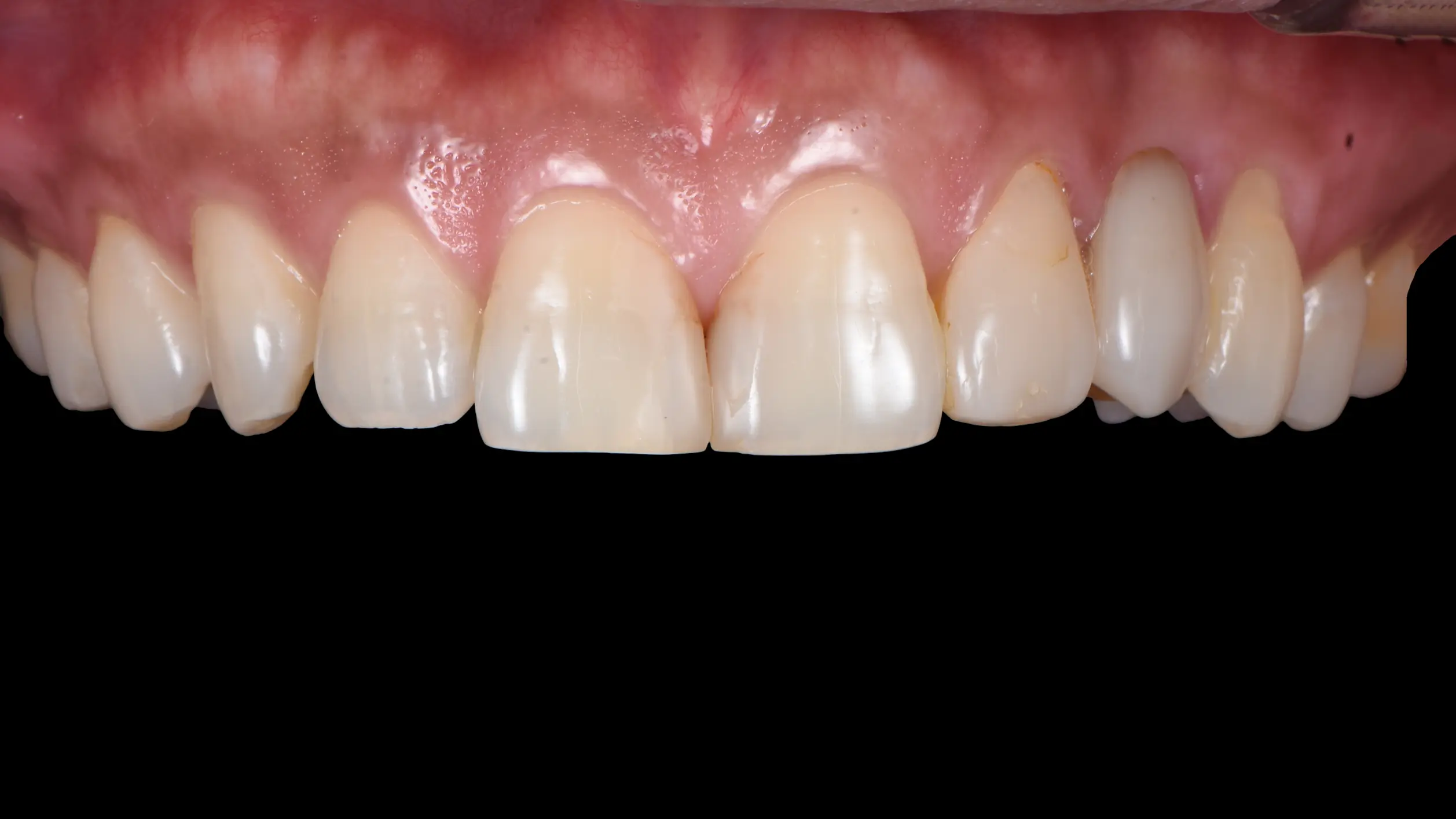 veneer3 upper pre rev01