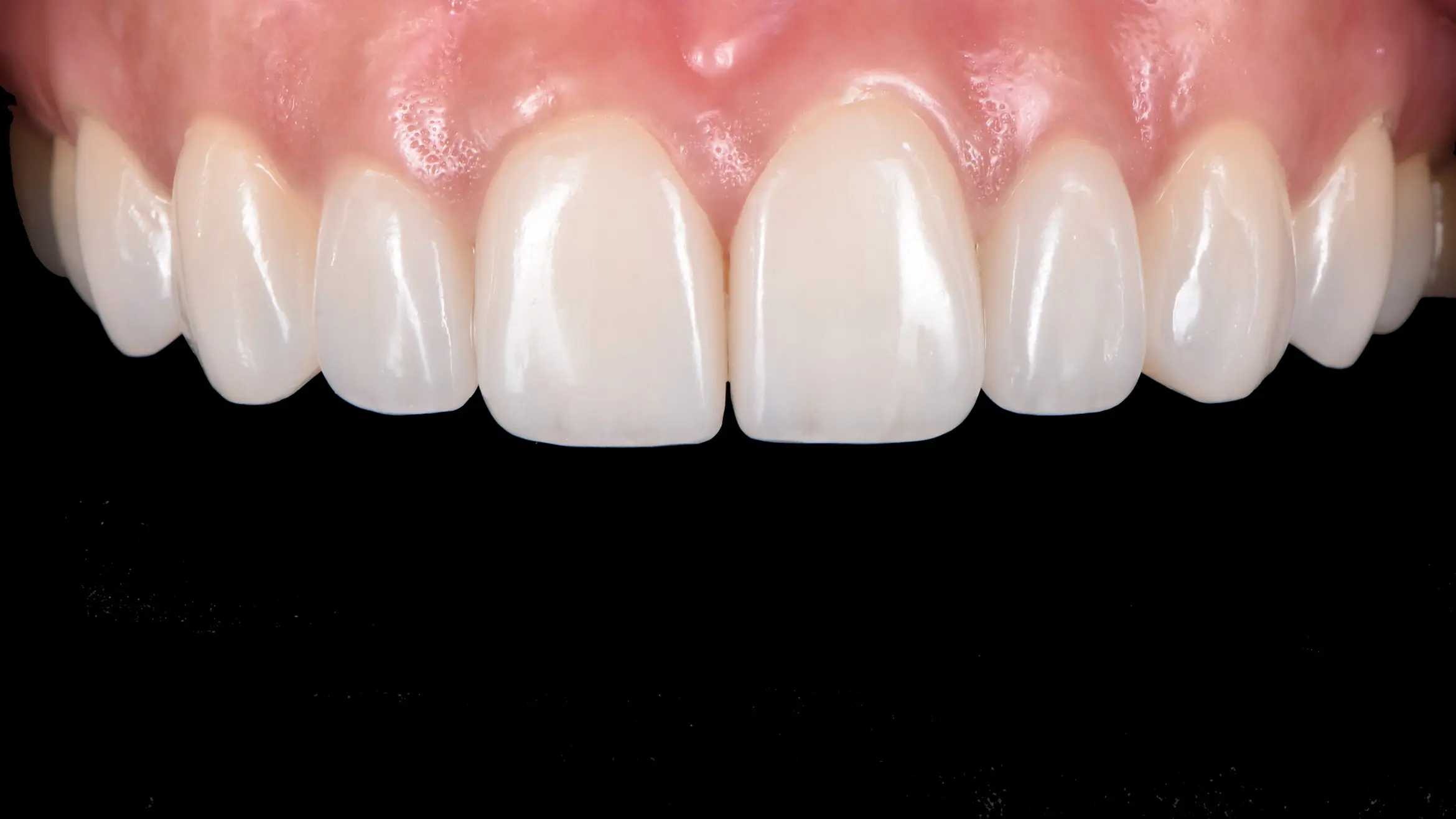 veneer4 upper post rev01