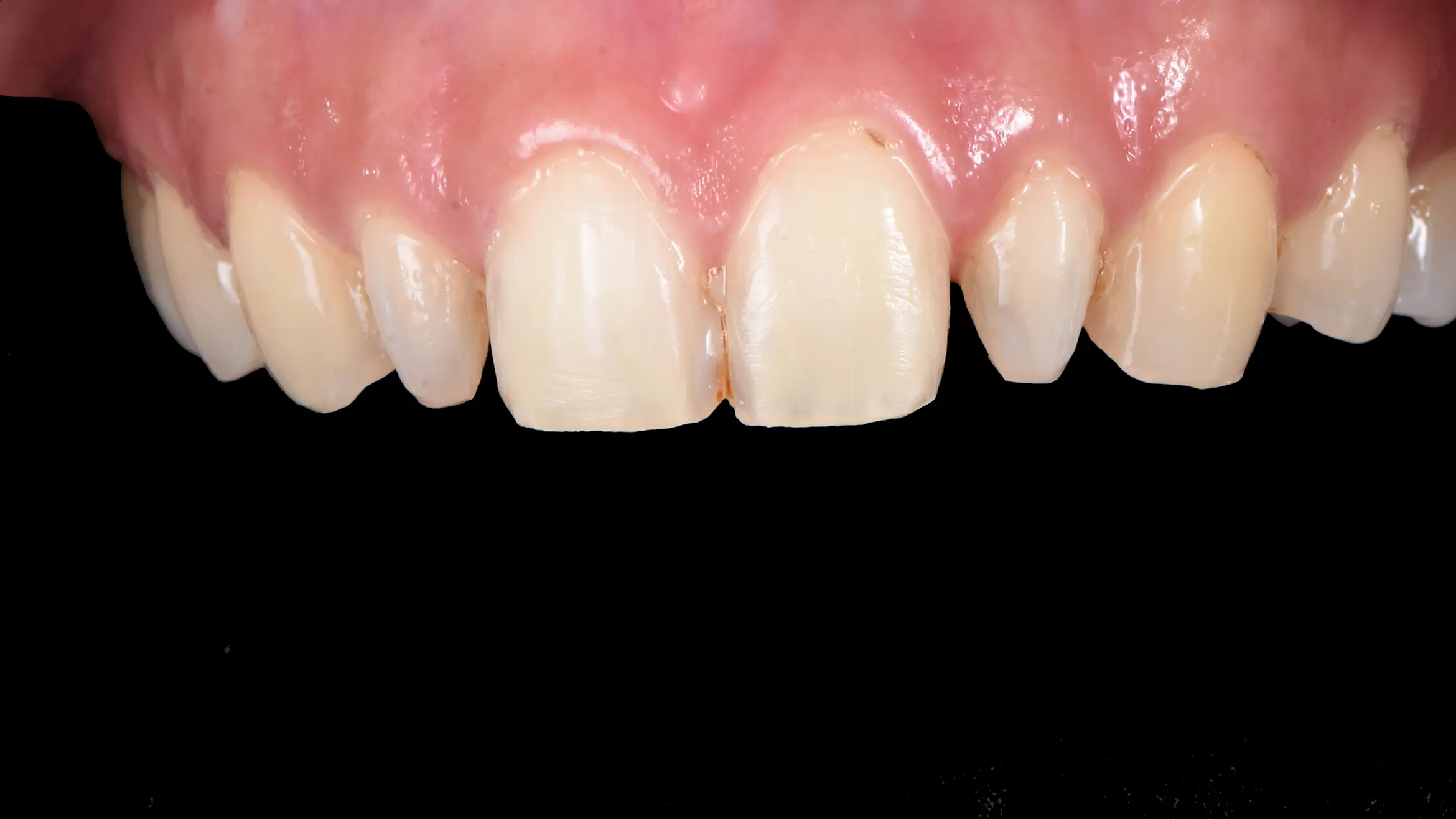 veneer4 upper pre rev01