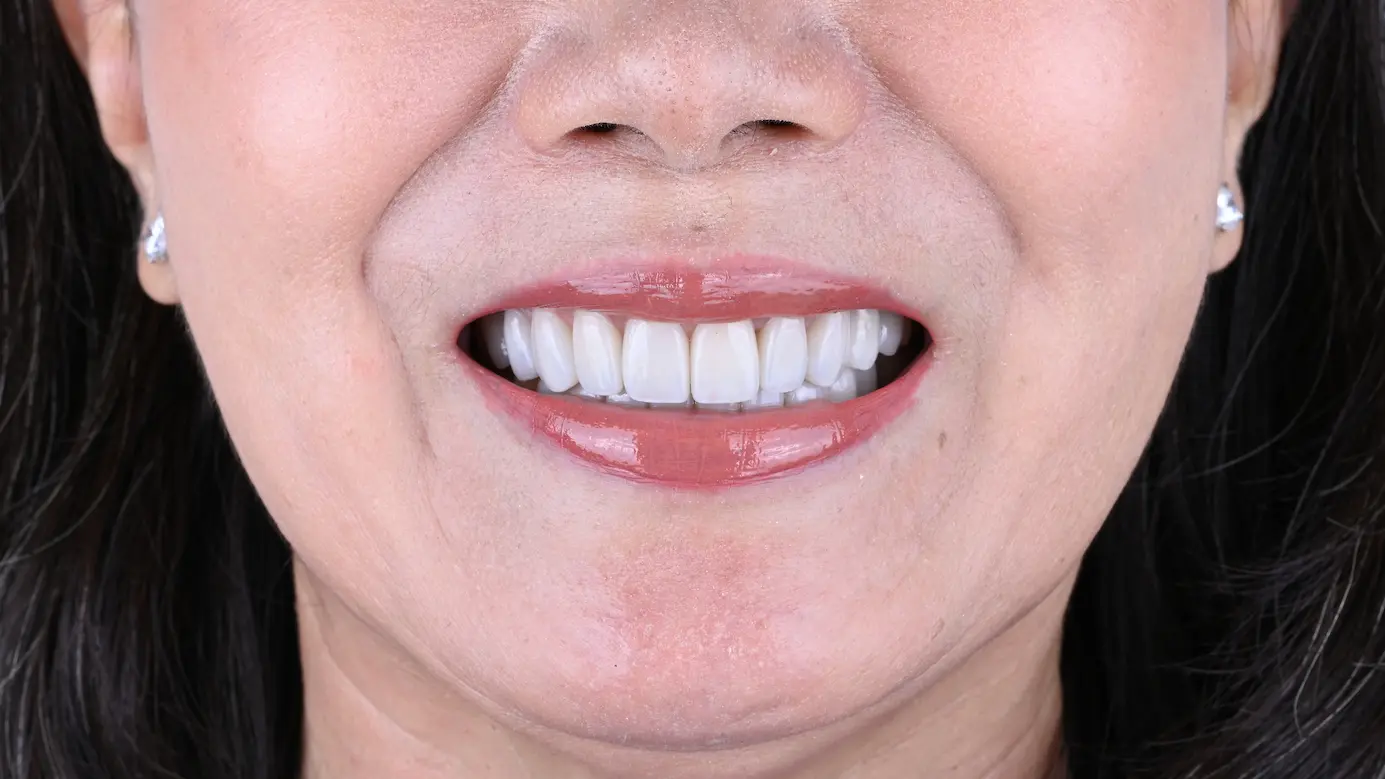 teeth Whitening after1