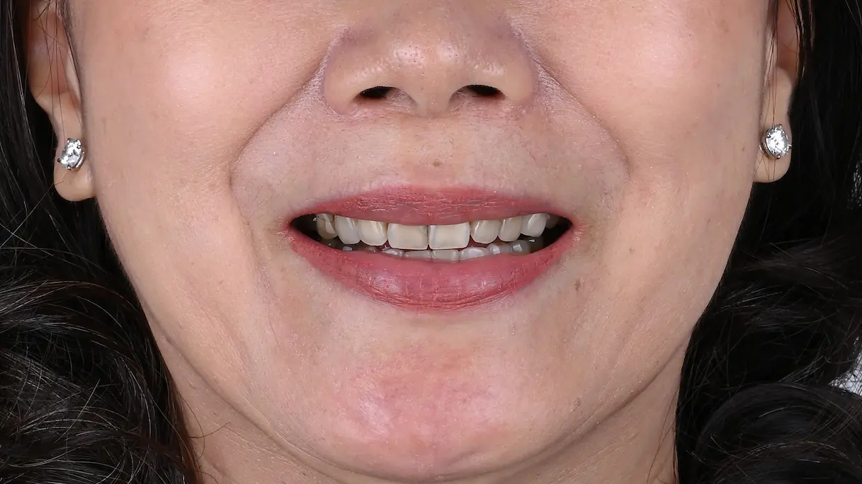 teeth Whitening before1