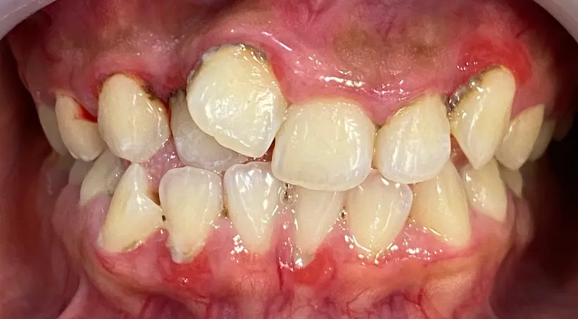 จัดฟัน เคส1 ก่อน