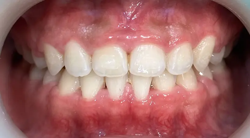 จัดฟัน เคส1 หลัง