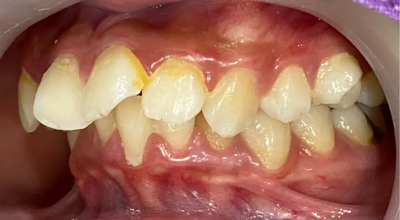 จัดฟัน เคส2 ก่อน