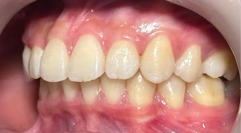 จัดฟัน เคส2 หลัง