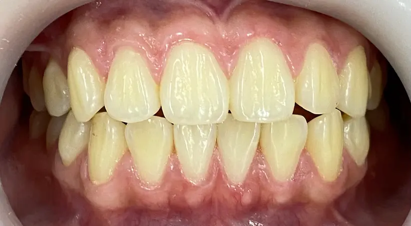 จัดฟัน เคส4 ก่อน