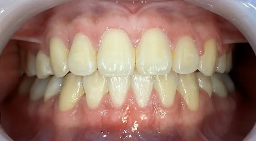 จัดฟัน เคส4 หลัง